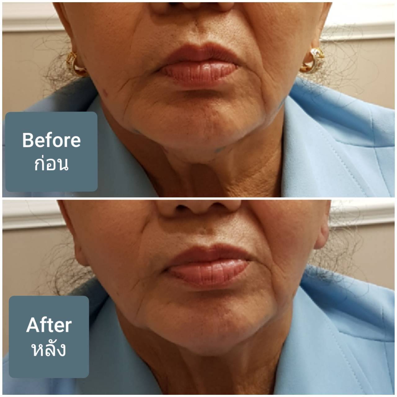 dermaplus clinic phuket - Filler